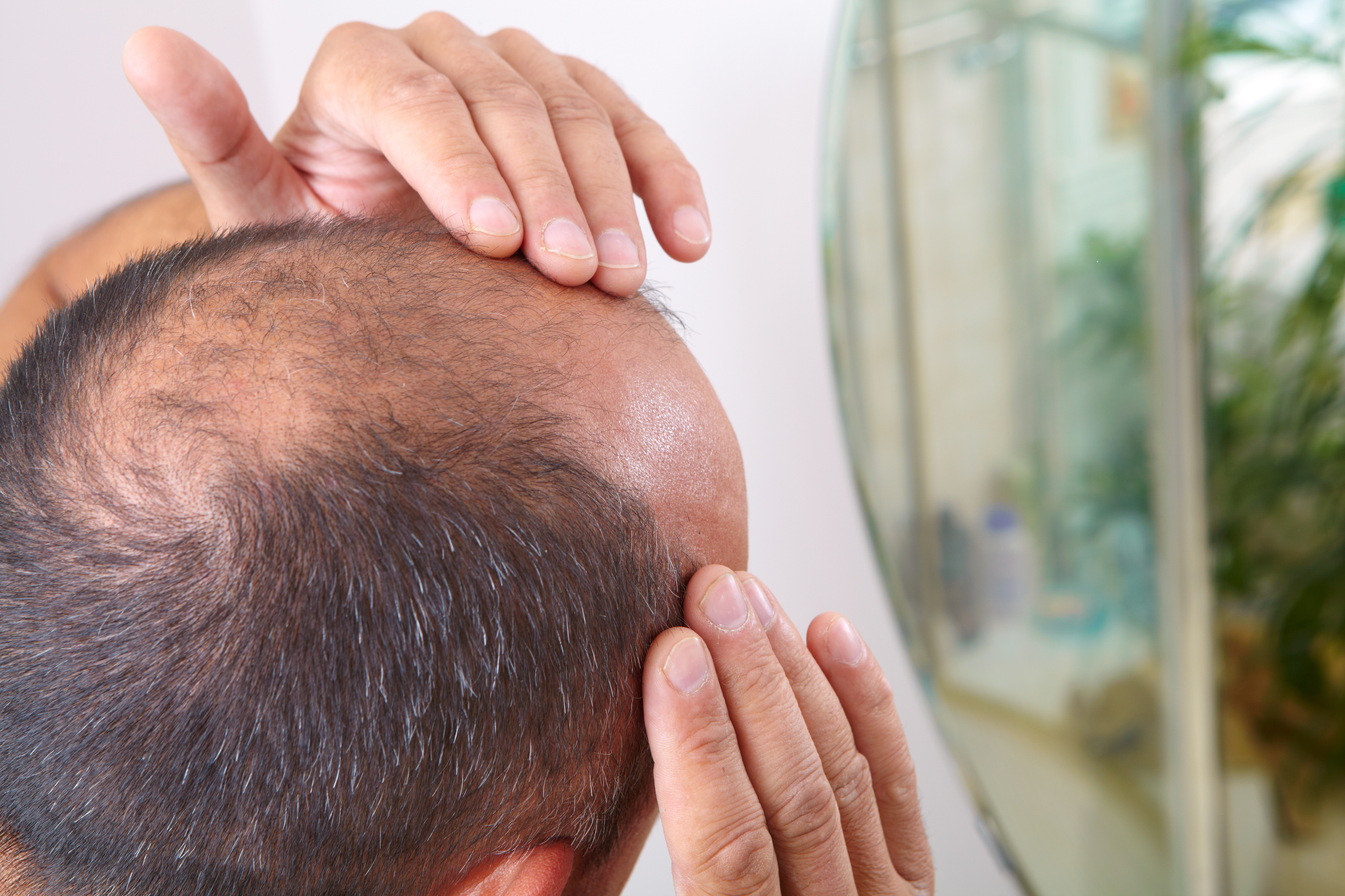 Hair loss may be a coronavirus symptom, study finds