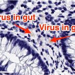 An 11-year-old with abdominal pain 3 months after getting COVID-19 still had the coronavirus in her gut