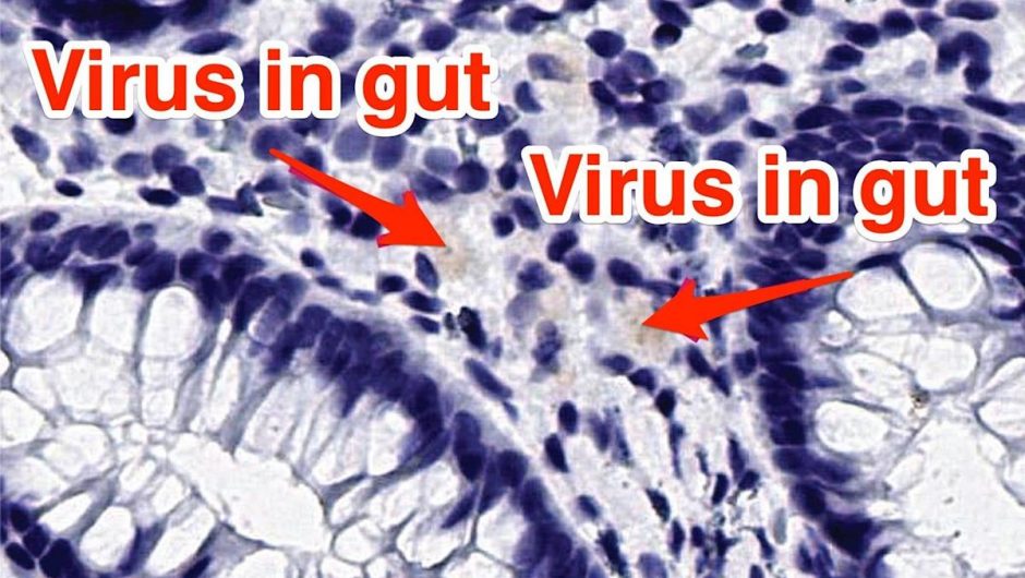 An 11-year-old with abdominal pain 3 months after getting COVID-19 still had the coronavirus in her gut