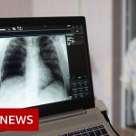 Some long Covid patients may have hidden damage to their lungs – BBC News