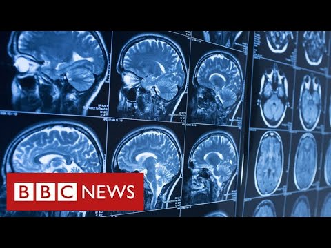 Covid survivors may face life-long brain injuries – BBC News