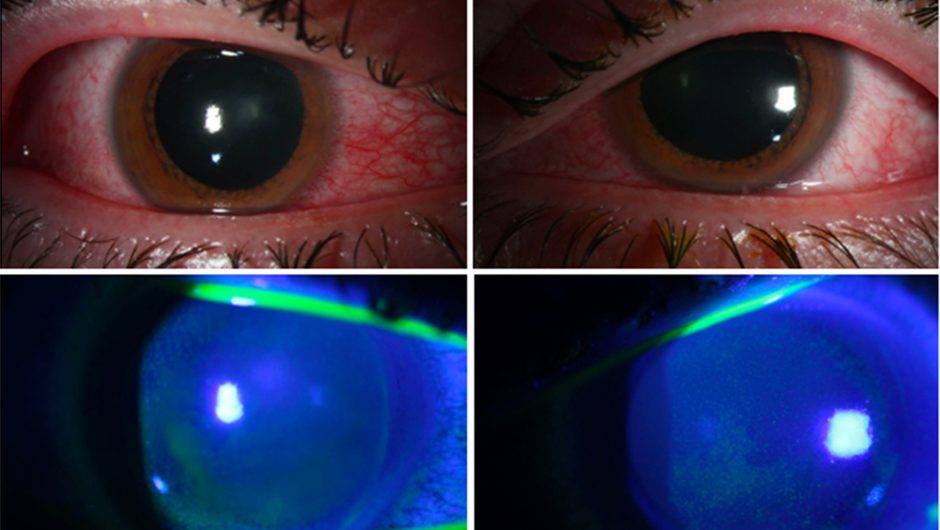 People damaging their eyes trying to kill COVID-19 with UV lamps